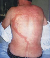 1276208528 2261 FT90810 Lichtenberg Figures Caused By Lightning 