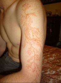 1391884435 543 FT161143 Lichtenberg Figures On Skin 